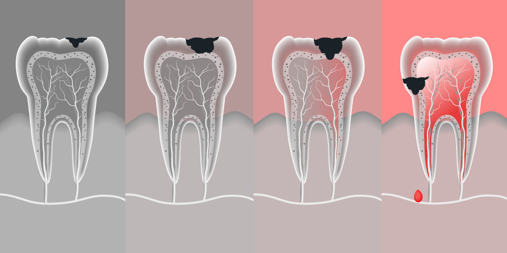 Progressione illustrata della carie verso i tessuti interni del dente.
