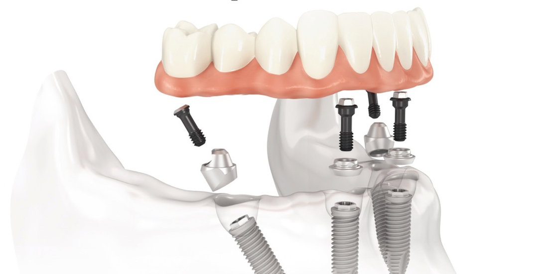 Esempio illustrativo di protesi sostenuta da impianti.