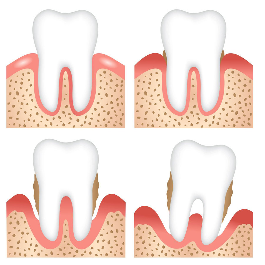 Confronto illustrato dei tessuti di sostegno del dente.
